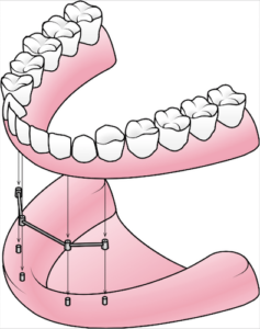 all on 4 dental implants